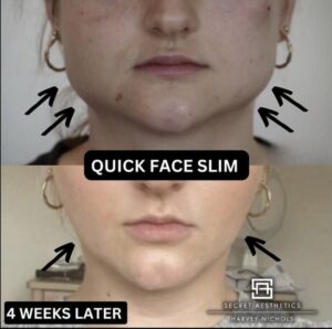 Mid face botox before and after birmingham