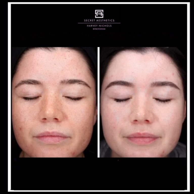Before and after BBL IPL treatment birmingham