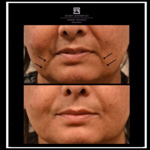 before and after filler birmingham