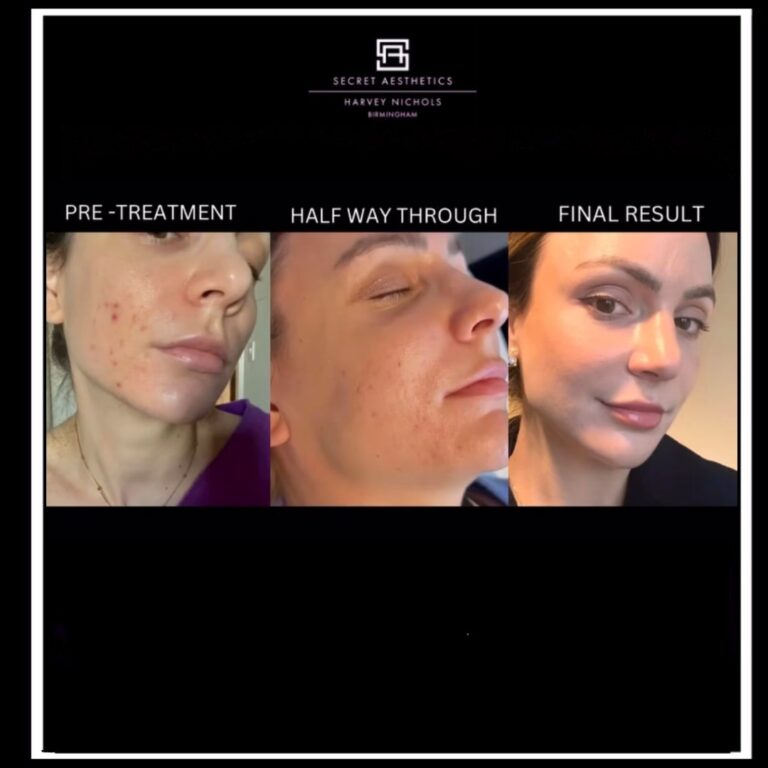 Before and after acne treatment birmingham