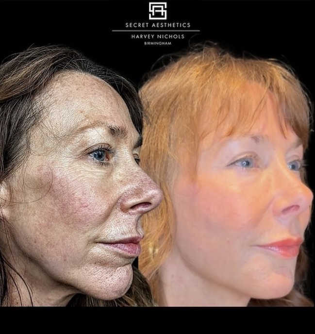 before and after skin resurfacing treatment birmingham