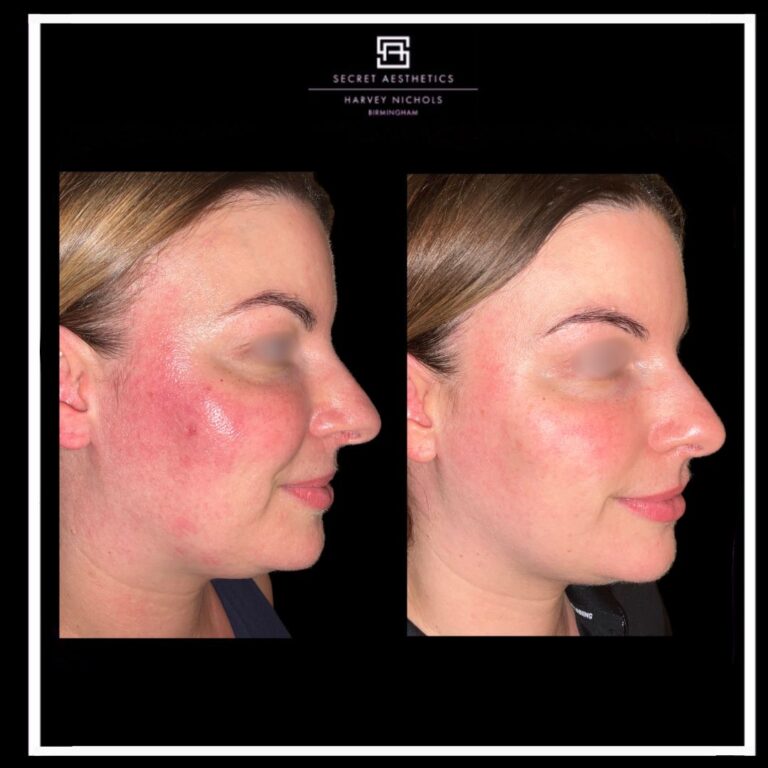 before and after skin resurfacing rosacea treatment birmingham