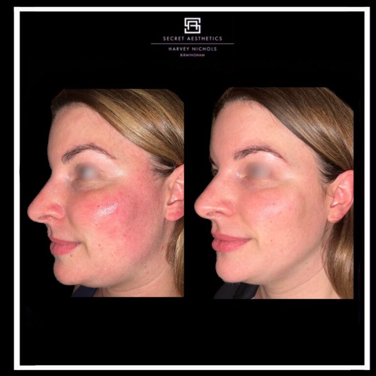 before and after rosacea treatment birmingham