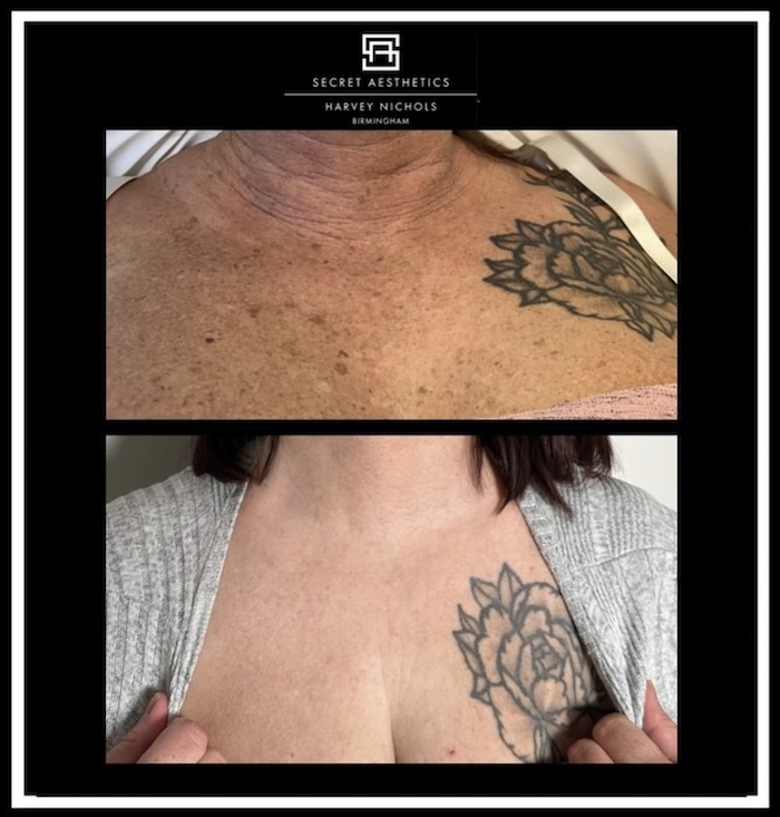 before and after pigmentation removal birmingham