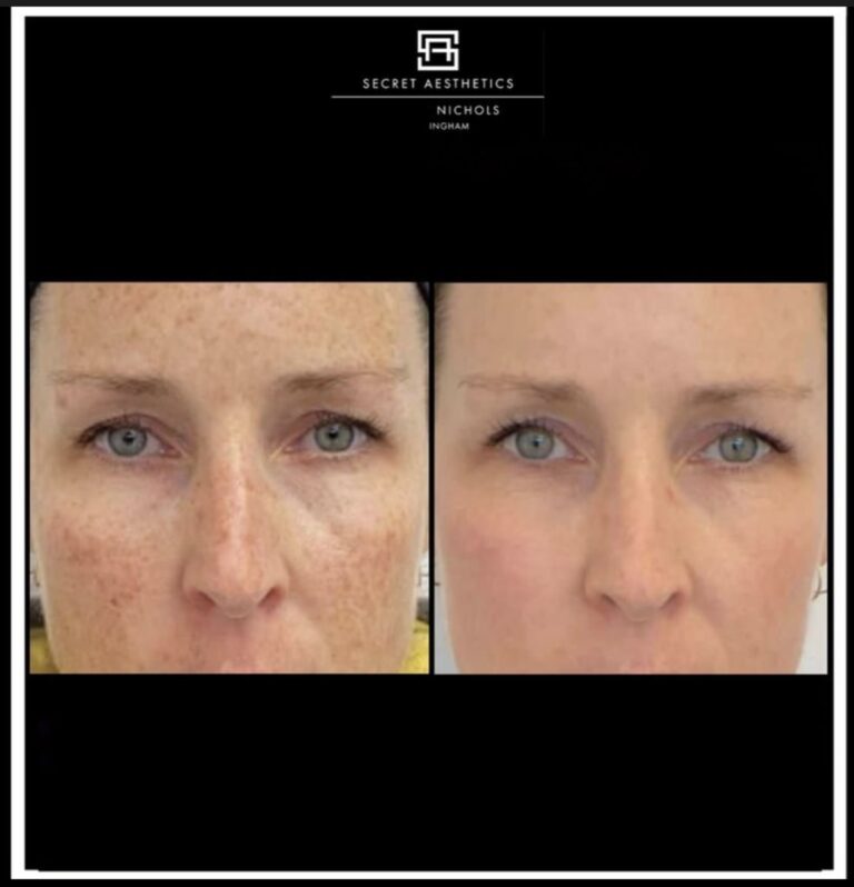 freckle removal birmingham
