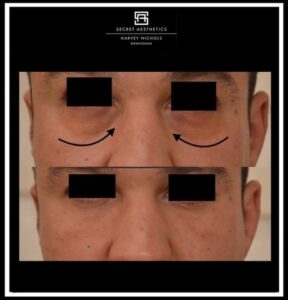 under eye filler before and after birmingham