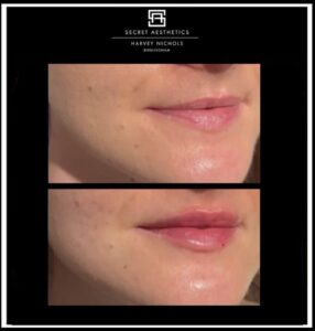 before and after lip fillers birmingham