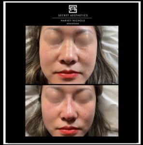 under eye filler before and after birmingham