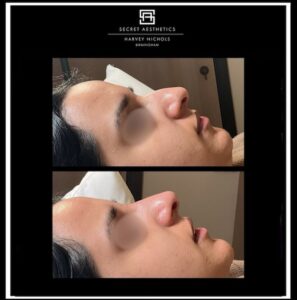 dermal fillers before and after birmingham
