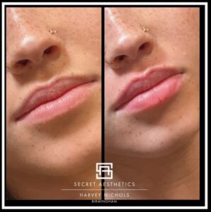 lip filler results birmingham