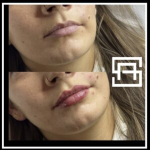 before and after jaw fillers lip fillers birmingham