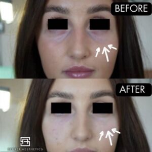under eye filler before and after birmingham