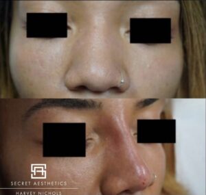 dermal fillers before and after birmingham