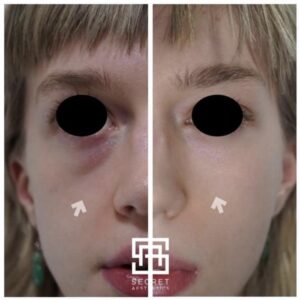 under eye filler before and after birmingham