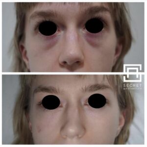 under eye filler before and after birmingham