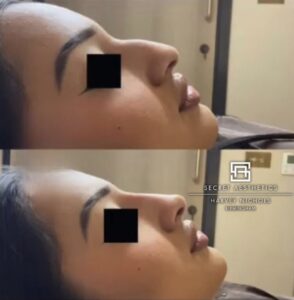 dermal fillers before and after birmingham