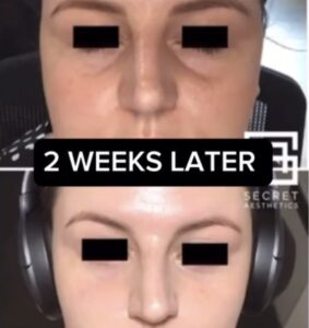 under eye filler before and after birmingham