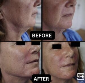 dermal fillers before and after birmingham