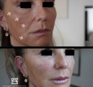 mid face fillers birmingham