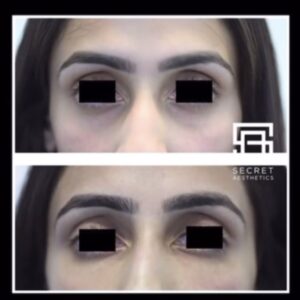 under eye filler before and after birmingham