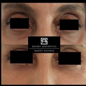 under eye fillers before and after birmingham