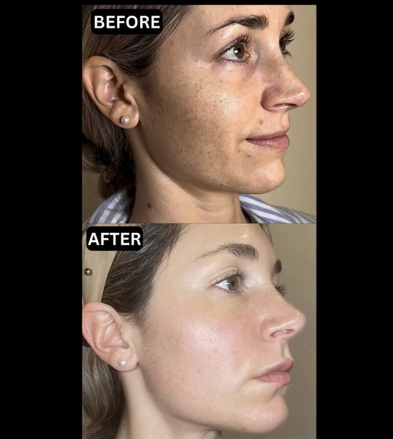 before and after sun damage removal birmingham