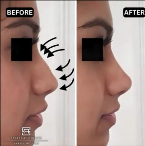 before and after nose filler birmingham