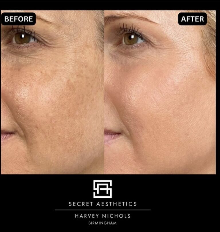 before and after freckles removal birmingham