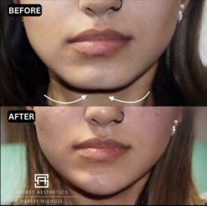 chin filler birmingham before and after