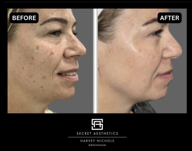 sun damaged skin removal birmingham