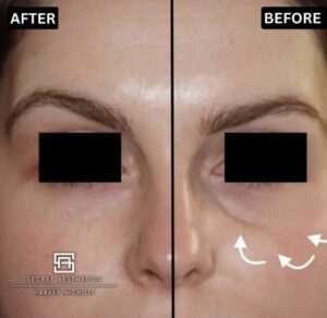 under eye filler before and after birmingham