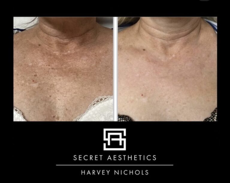 freckles on chest removal before and after birmingham