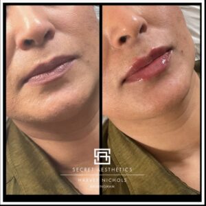 lip fillers before and after birmingham