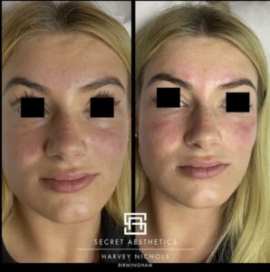 dermal fillers before and after birmingham