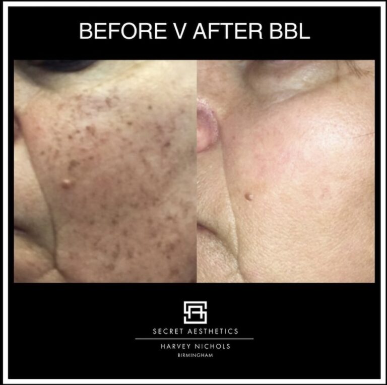 hyperpigmentation removal before and after birmingham