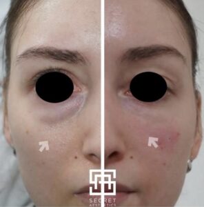 tear trough filler before and after birmingham