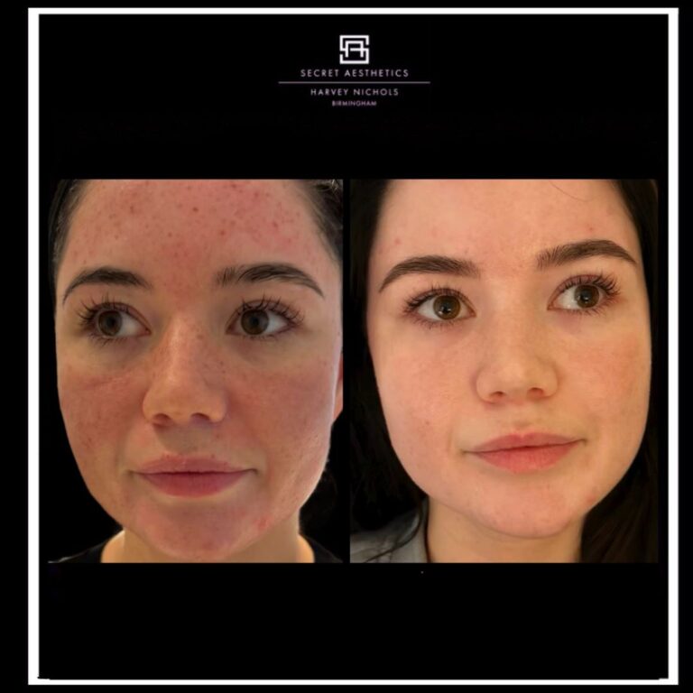 before and after freckle removal birmingham