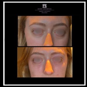 under eye filler before and after birmingham