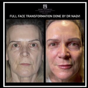 Full Face Transformation (1)