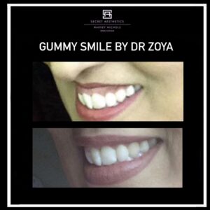 Gummy Smile Botox