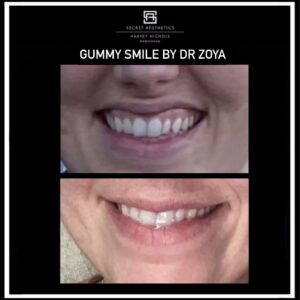 Gummy smile