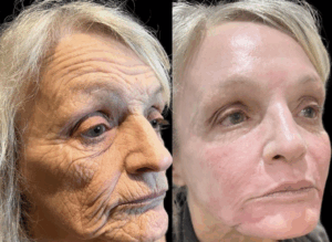 Ablative Lasers Birmingham – Dr Zoya at Secret Aesthetics
