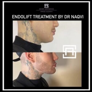 Endolift Treatment by Dr Naqvi