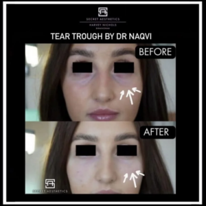 Tear trough before and after by Dr Naqvi