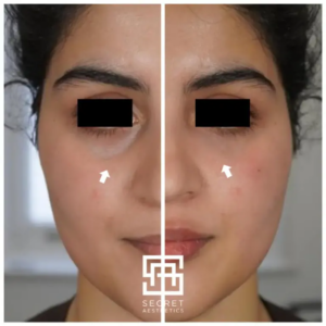 Signature 3-in-1 eye rejuvenation before and after